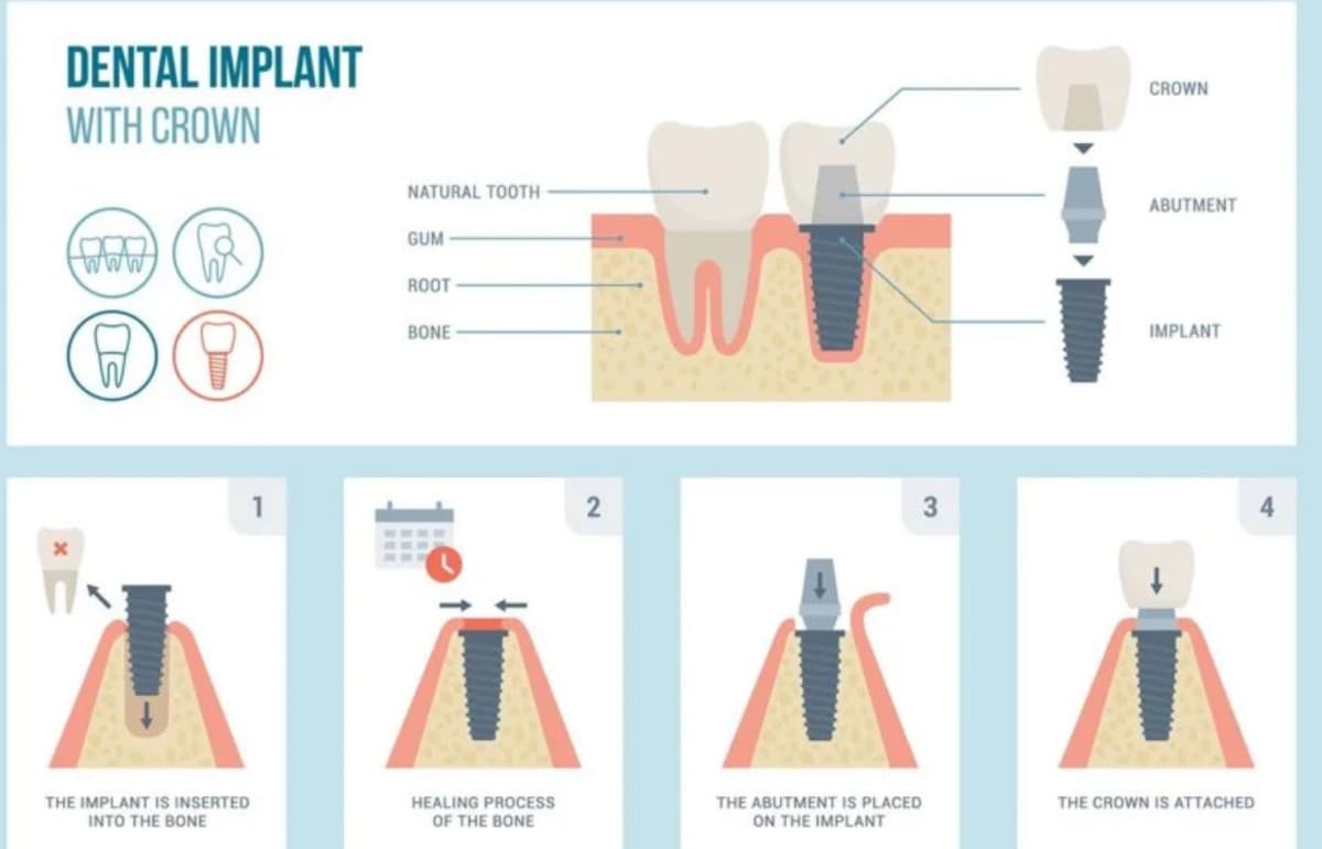 Fort Worth Dental Practice Offers Affordable Implant Solutions Through In-House Technology and Transparent Pricing