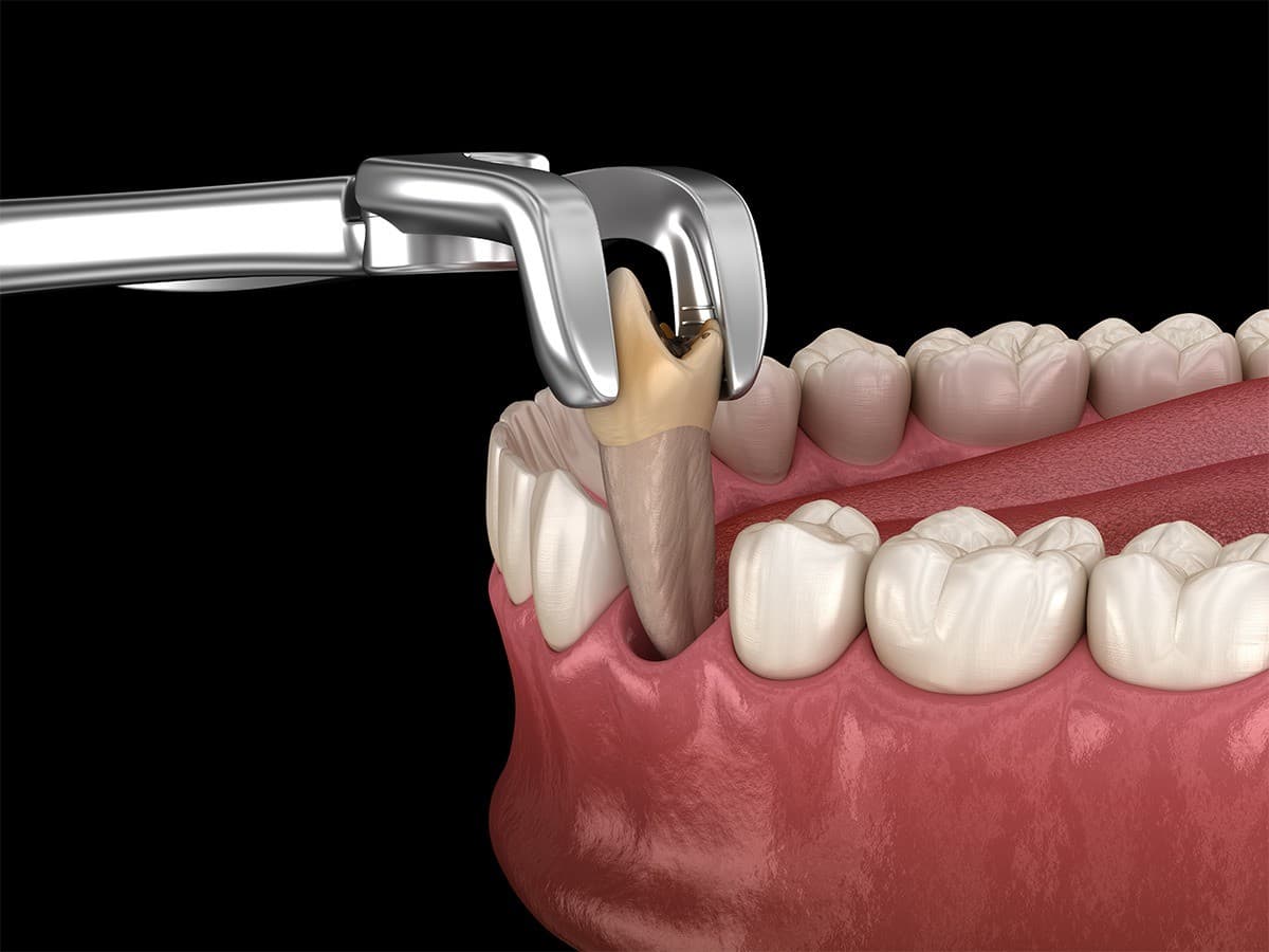Sioux Falls Oral Surgery Practice Publishes Extraction Guide to Reduce Patient Anxiety